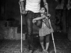 A young girl is holding on to a man who is missing his left leg from the knee down. He is on crutches.