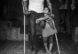 A young girl is holding on to a man who is missing his left leg from the knee down. He is on crutches.